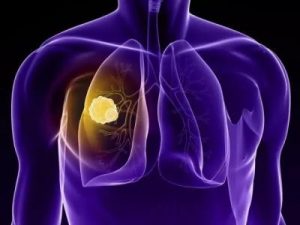 克唑替尼+色瑞替尼序貫治療NSCLC